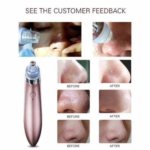 (3PK) Blackhead Remover Vacuum